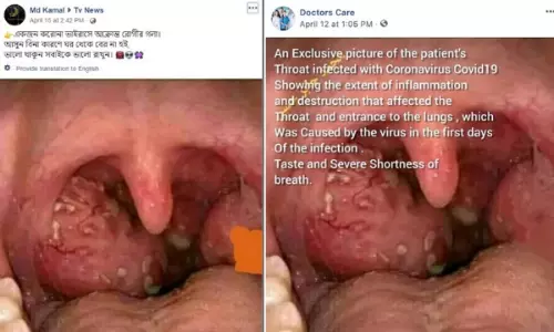 এটি করোনাভাইরাস আক্রান্ত রোগীর গলা নয় এটি করোনাভাইরাস আক্রান্ত রোগীর গলা নয়