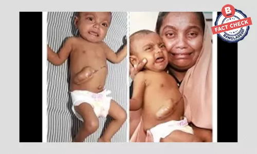 ছবিটি ভারতের অসুস্থ শিশুর, বাংলাদেশের দাবি করে সাহায্যের ভুয়া আবেদন ছবিটি ভারতের অসুস্থ শিশুর, বাংলাদেশের দাবি করে সাহায্যের ভুয়া আবেদন